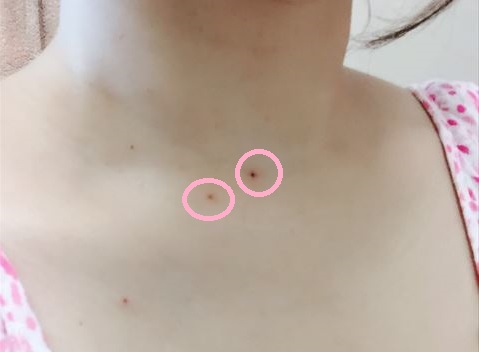 シンガポールで安くほくろが除去できる Point D Beaute ポワン ド ボーテ シンガポール情報館 Sing Info